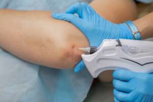 Elbow cortisol injection being given. the medical person is wearing blue gloves and holds a medical device injection